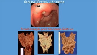 ÚLCERA PÉPTICA GÁSTRICA
Transformação para Carcinoma Gástrico
UPG
 