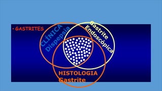 • GASTRITES
HISTOLOGIA
Gastrite
 
