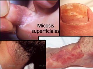 Micosis
superficiales
10/08/2018 Bioq. Christian Alvarez
 