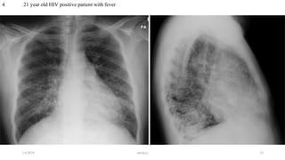 4 21 year old HIV positive patient with fever
1/4/2018 abrakca 10
 