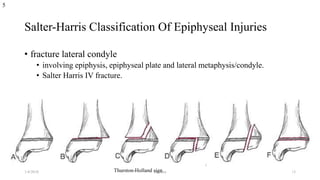 Salter-Harris Classification Of Epiphyseal Injuries
• fracture lateral condyle
• involving epiphysis, epiphyseal plate and lateral metaphysis/condyle.
• Salter Harris IV fracture.
5
Thurston-Holland sign.1/4/2018 abrakca 13
 