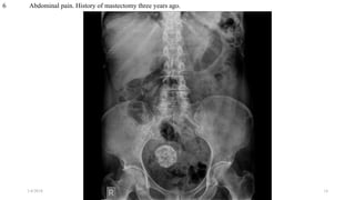 6 Abdominal pain. History of mastectomy three years ago.
1/4/2018 abrakca 14
 