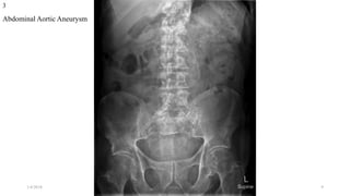 Abdominal Aortic Aneurysm
3
1/4/2018 abrakca 9
 