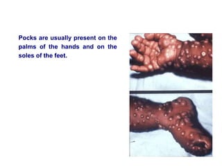 Pocks are usually present on the
palms of the hands and on the
soles of the feet.
 