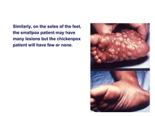 Similarly, on the soles of the feet,
the smallpox patient may have
many lesions but the chickenpox
patient will have few or none.
 