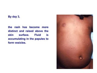 By day 3,
the rash has become more
distinct and raised above the
skin surface. Fluid is
accumulating in the papules to
form vesicles.
 