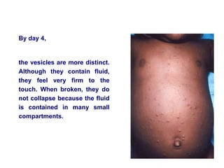 By day 4,
the vesicles are more distinct.
Although they contain fluid,
they feel very firm to the
touch. When broken, they do
not collapse because the fluid
is contained in many small
compartments.
 