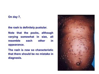 On day 7,
the rash is definitely pustular.
Note that the pocks, although
varying somewhat in size, all
resemble each other in
appearance.
The rash is now so characteristic
that there should be no mistake in
diagnosis.
 