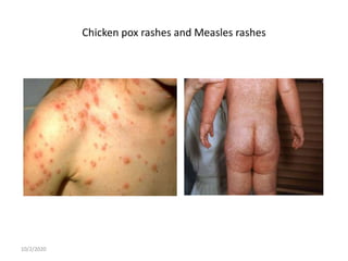 Chicken pox rashes and Measles rashes
10/2/2020
 