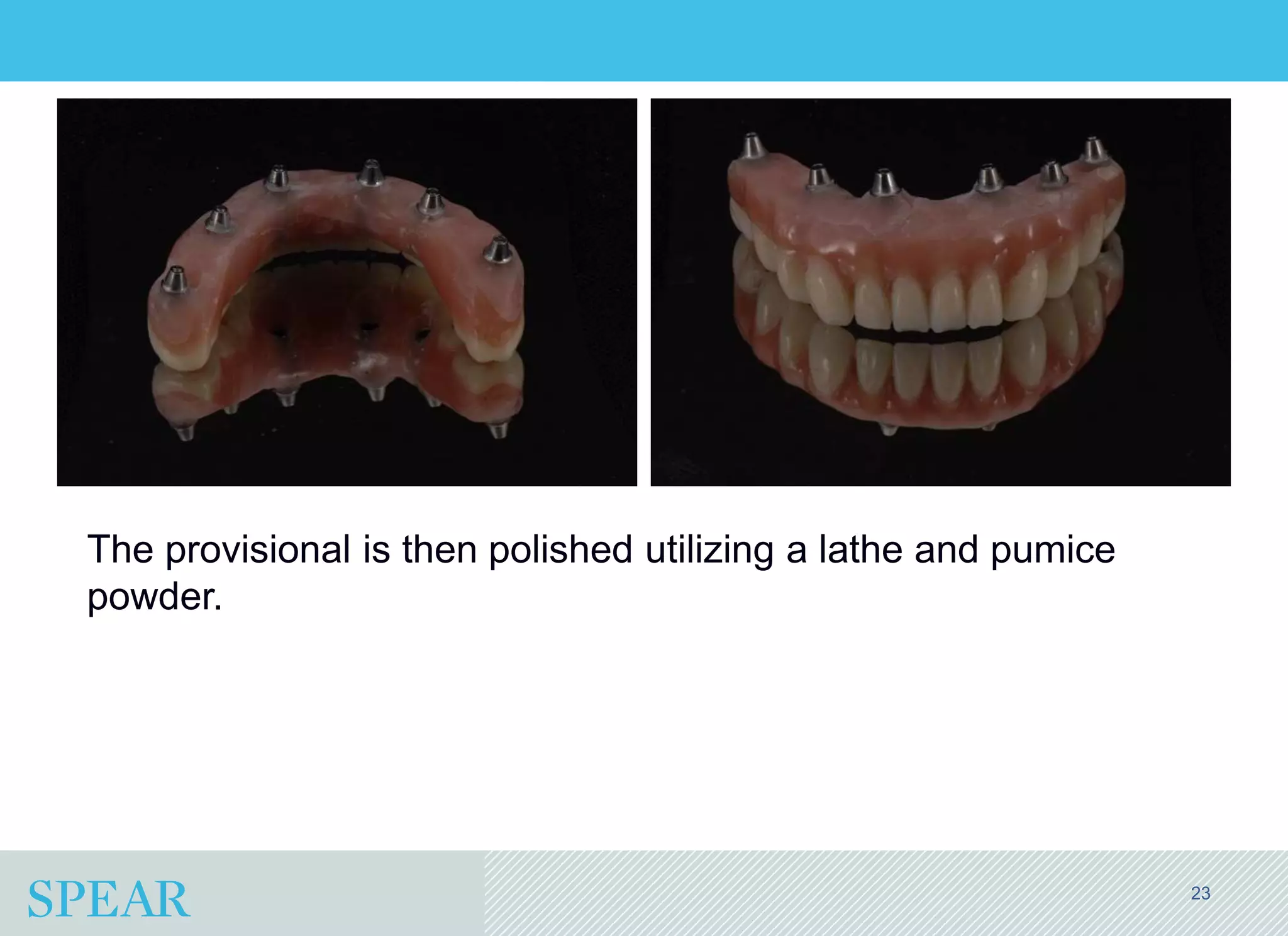 Conversion Prosthesis For an Implant-Supported Fixed Dental Prosthesis ...