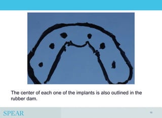 Conversion Prosthesis For an Implant-Supported Fixed Dental Prosthesis ...