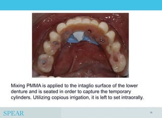 Conversion Prosthesis For an Implant-Supported Fixed Dental Prosthesis ...