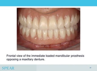 Conversion Prosthesis For an Implant-Supported Fixed Dental Prosthesis ...