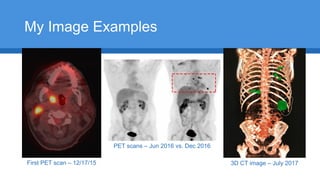My Image Examples
First PET scan – 12/17/15
PET scans – Jun 2016 vs. Dec 2016
3D CT image – July 2017
 