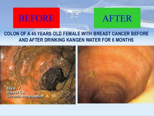 kangen water colon cancer
