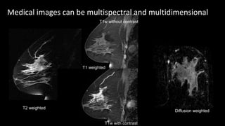 Medical images can be multispectral and multidimensional
T2 weighted
T1 weighted
Diffusion weighted
T1w with contrast
T1w without contrast
 