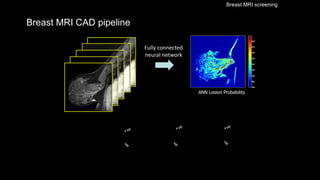Breast MRI CAD pipeline
ANN Lesion Probability
Fully connected
neural network
Breast MRI screening
 