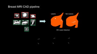 Breast MRI CAD pipeline
RFC Lesion Detection
Lesions Non-Lesions
False positive
detection removal
 