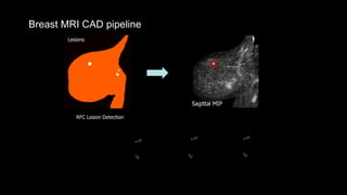 Breast MRI CAD pipeline
RFC Lesion Detection
Lesions
Sagittal MIP
Lesion
Classification
 
