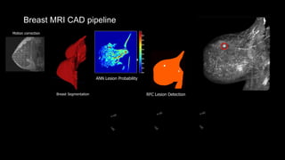 Breast Segmentation
Breast MRI CAD pipeline
Lesion
Classification
Motion correction
RFC Lesion Detection
ANN Lesion Probability
 
