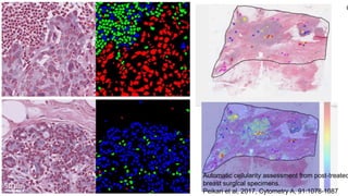 Assessing tumour burden
C
Automatic cellularity assessment from post-treated
breast surgical specimens.
Peikari et al, 2017, Cytometry A, 91:1078-1087
 