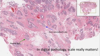 In digital pathology, scale really matters!
Normal duct
Duct carcinoma in situ
 