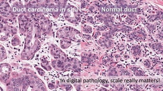 Duct carcinoma in situ Normal duct
In digital pathology, scale really matters!
 