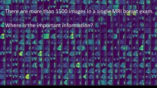 There are more than 1500 images in a single MRI breast exam.
Where is the important information?
 