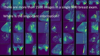 There are more than 1500 images in a single MRI breast exam.
Where is the important information?
 