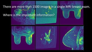 There are more than 1500 images in a single MRI breast exam.
Where is the important information?
 
