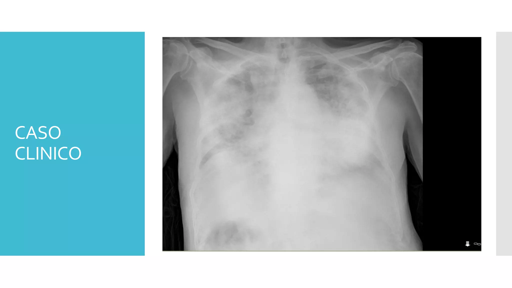 CASO
CLINICO
 