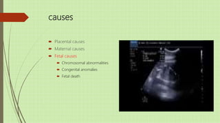 causes
 Placental causes
 Maternal causes
 Fetal causes
 Chromosomal abnormalities
 Congenital anomalies
 Fetal death
 