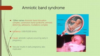 Amniotic band syndrome
 Other names-Amniotic band disruption
complex, constriction band syndrome, amniotic
deformity, adhesions, mutilations complex
 Incidence: 0.89/10,000 births
 Cause: amniotic rupture occurring early in
pregnancy
 Vascular insults in early pregnancy also
implicated
 
