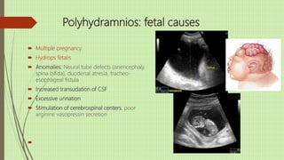 Polyhydramnios: fetal causes
 Multiple pregnancy
 Hydrops fetalis
 Anomalies: Neural tube defects (anencephaly,
spina bifida), duodenal atresia, tracheo-
esophageal fistula
 Increased transudation of CSF
 Excessive urination
 Stimulation of cerebrospinal centers, poor
arginine vasopressin secretion

 