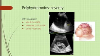 Polyhydramnios: severity
With sonography:
 Mild 8-11cm 80%
 Moderate 12-15cm 15%
 Severe >16cm 5%
 