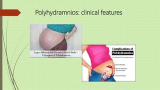 Polyhydramnios: clinical features
 Dyspnea
 Edema
 Oliguria
 Dyspepsia
 