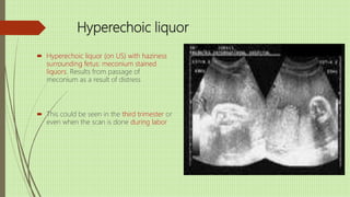 Hyperechoic liquor
 Hyperechoic liquor (on US) with haziness
surrounding fetus: meconium stained
liquors. Results from passage of
meconium as a result of distress
 This could be seen in the third trimester or
even when the scan is done during labor
 