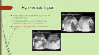Hyperechoic liquor
 When hazy liquor is detected, try to find the
underlying cause
 Amnioscopy (if the cervix is dilated), can
confirm the diagnosis of meconium.
 Delivery on an urgent basis to rescue the
fetus.
 