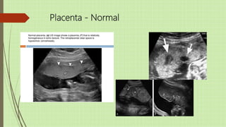 Placenta - Normal
 