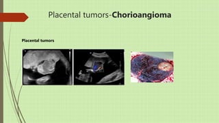 Placental tumors-Chorioangioma
Placental tumors
 