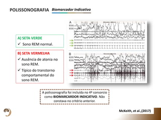 B) SETA VERMELHA
 Ausência de atonia no
sono REM.
 Típico do transtorno
comportamental do
sono REM.
POLISSONOGRAFIA Biomarcador Indicativo
McKeith, et al.,(2017)
A polissonografia foi incluída no 4º consorcio
como BIOMARCARDOR INDICATIVO. Não
constava no critério anterior.
A) SETA VERDE
 Sono REM normal.
 