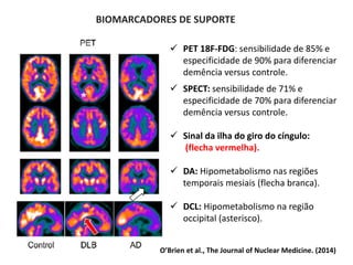  PET 18F-FDG: sensibilidade de 85% e
especificidade de 90% para diferenciar
demência versus controle.
 SPECT: sensibilidade de 71% e
especificidade de 70% para diferenciar
demência versus controle.
 Sinal da ilha do giro do cíngulo:
(flecha vermelha).
 DA: Hipometabolismo nas regiões
temporais mesiais (flecha branca).
 DCL: Hipometabolismo na região
occipital (asterisco).
BIOMARCADORES DE SUPORTE
O’Brien et al., The Journal of Nuclear Medicine. (2014)
 