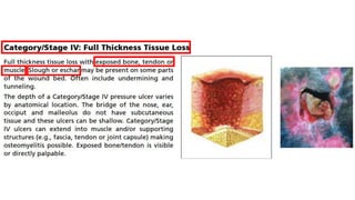 Prevention and Treatment of Pressure Ulcers: Quick Reference Guide | PDF