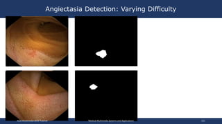Angiectasia Detection: Varying Difficulty
ACM Multimedia 2019 Tutorial Medical Multimedia Systems and Applications 121
 