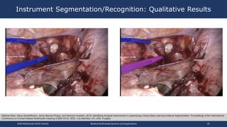Instrument Segmentation/Recognition: Qualitative Results
ACM Multimedia 2019 Tutorial Medical Multimedia Systems and Applications 45
Sabrina Kletz, Klaus Schoeffmann, Jenny Benois-Pineau, and Heinrich Husslein. 2019. Identifying Surgical Instruments in Laparoscopy Using Deep Learning Instance Segmentation. Proceedings of the International
Conference on Content-Based Multimedia Indexing (CBMI 2019). IEEE, Los Alamitos, CA, USA, 6 pages
 