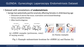 • Dataset with annotations of endometriosis
• benign but potentially painful anomaly affecting females in child-bearing age
• Dislocation of uterine-like tissue; cicatrization and enclosed bleedings
• Serious and painful disease
• Often hard to diagnose
GLENDA: Gynecologic Laparoscopy Endometriosis Dataset
ACM Multimedia 2019 Tutorial Medical Multimedia Systems and Applications 48
 