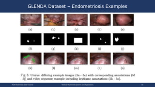 GLENDA Dataset – Endometriosis Examples
ACM Multimedia 2019 Tutorial Medical Multimedia Systems and Applications 50
 