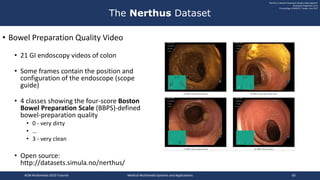 • Bowel Preparation Quality Video
• 21 GI endoscopy videos of colon
• Some frames contain the position and
configuration of the endoscope (scope
guide)
• 4 classes showing the four-score Boston
Bowel Preparation Scale (BBPS)-defined
bowel-preparation quality
• 0 - very dirty
• …
• 3 - very clean
• Open source:
http://datasets.simula.no/nerthus/
The Nerthus Dataset
"Nerthus: A Bowel Preparation Quality Video Dataset"
Konstantin Pogorelov, et al.
Proceedings of MMSYS, Taiwan, June 2017
ACM Multimedia 2019 Tutorial Medical Multimedia Systems and Applications 82
 