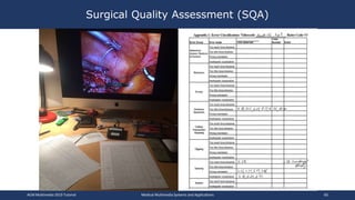 Surgical Quality Assessment (SQA)
ACM Multimedia 2019 Tutorial Medical Multimedia Systems and Applications 60
 