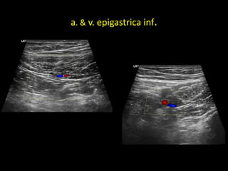 a. & v. epigastrica inf.
 